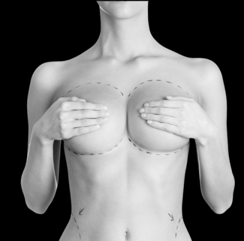 Breast augmentation in the Dominican Republic — balanced, natural shape