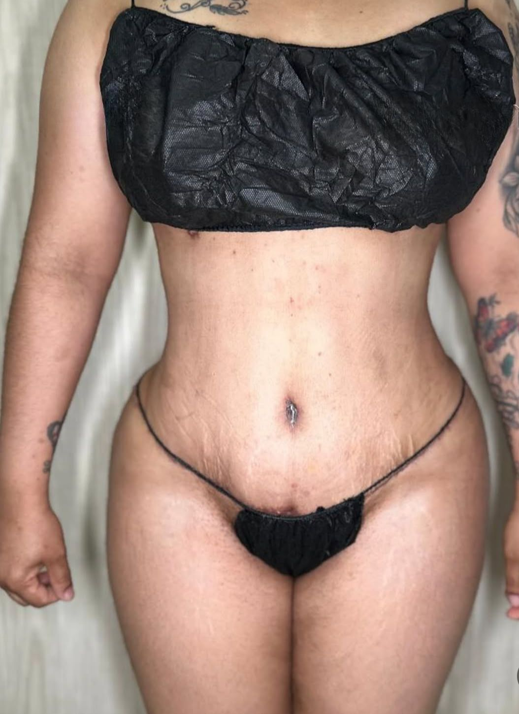 Abdominoplasty after result in Santo Domingo