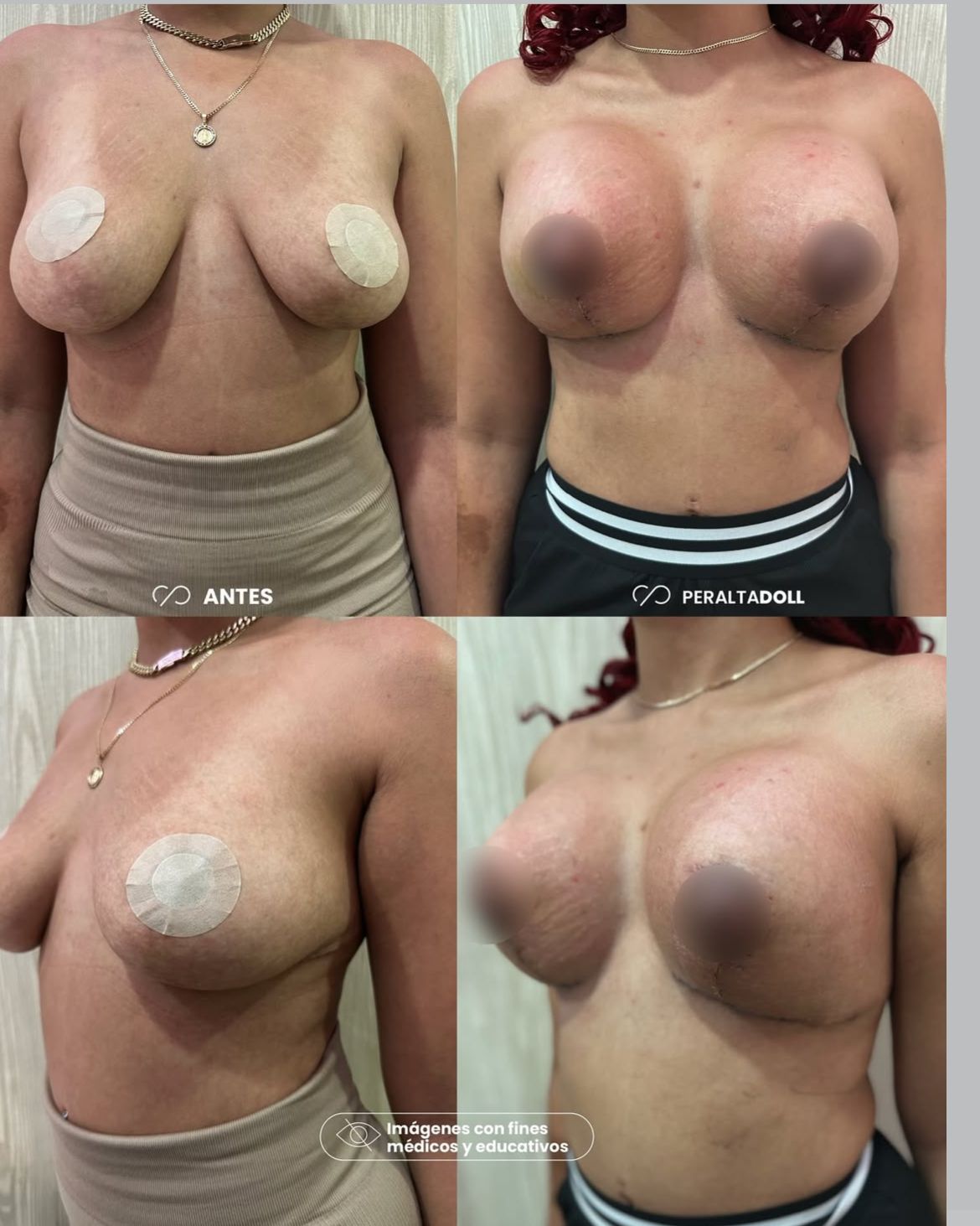 Breast lift with implants result as part of mommy makeover in Santo Domingo