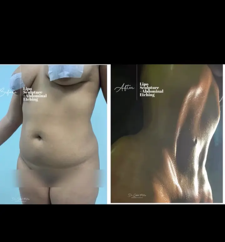 Liposuction with abdominal etching result in Santo Domingo