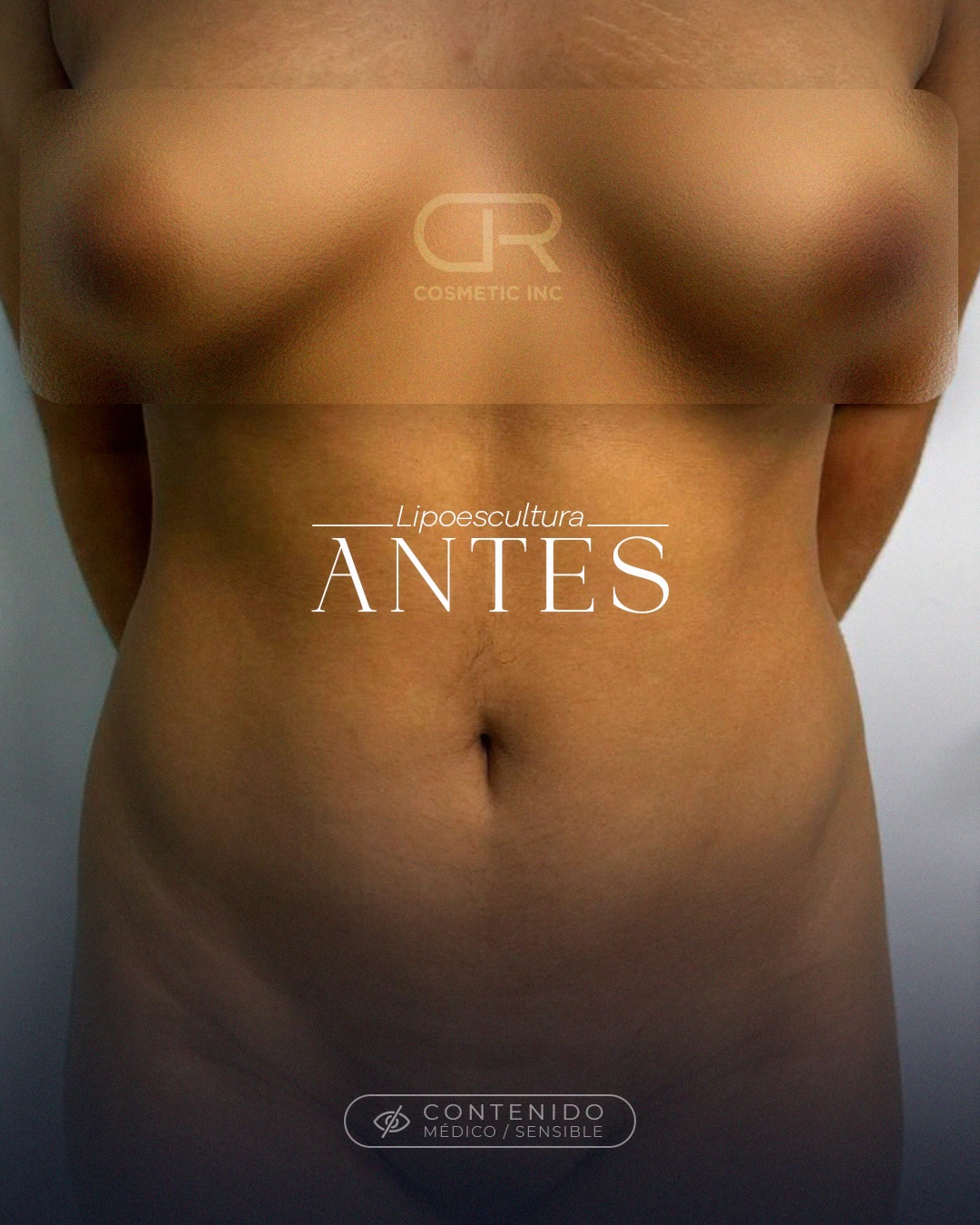 Liposuction before photo in Santo Domingo by DR Cosmetic Inc