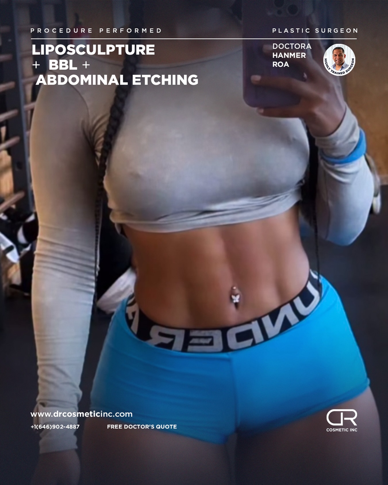 Liposculpture with BBL and abdominal etching result in Santo Domingo by DR Cosmetic Inc