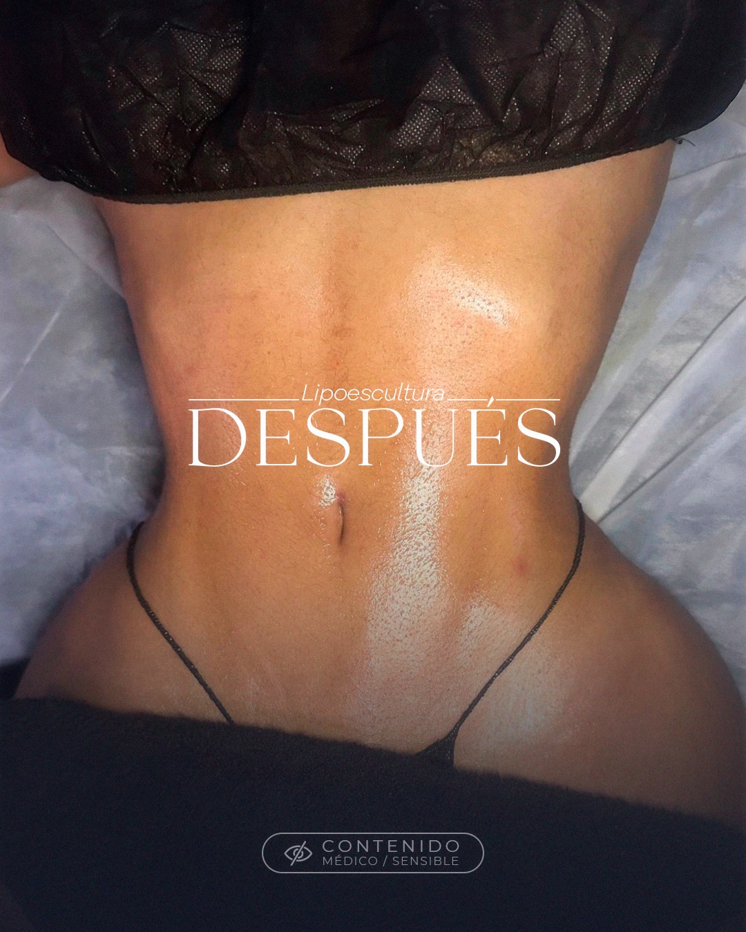 Body contouring result after liposuction in Santo Domingo by DR Cosmetic Inc